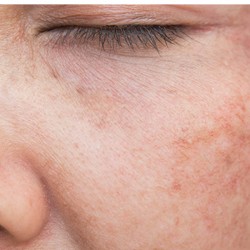 Light Related Skin Disease...