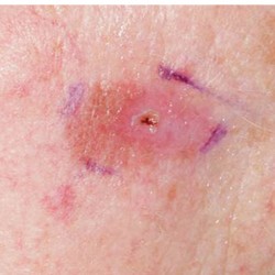 Melanoma & Other Skin Cancers